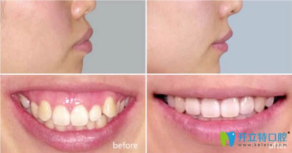 28歲凸嘴牙齒矯正前后對比照 28歲凸嘴牙齒矯正前后對比照