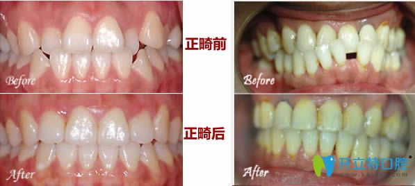 26歲輕微牙齒不齊矯正和28歲反頜且牙齒間隙正畸前后對比照 26歲輕微牙齒不齊矯正和28歲反頜且牙齒間隙正畸前后對比照