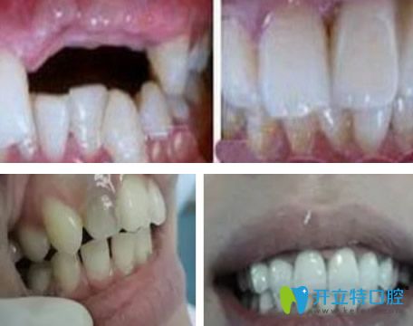 廣州瑞德口腔王玉棟醫(yī)生種植牙+全瓷貼面修復(fù)效果對(duì)比圖