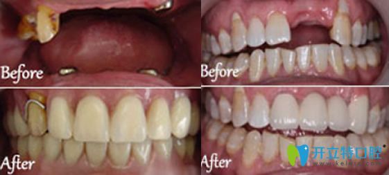 廣東東莞特美口腔半口牙缺失+單顆牙缺失種植案例 廣東東莞特美口腔半口牙缺失+單顆牙缺失種植案例