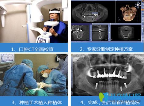 白振鑾主任微創(chuàng)無痛種植牙過程 白振鑾主任微創(chuàng)無痛種植牙過程