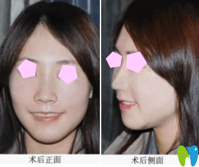 看了湛江口腔排名和收費(fèi)，選擇在南方口腔做牙齒矯正