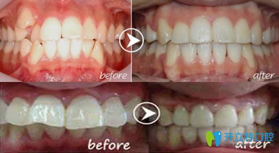 特美口腔隱形牙齒矯正案例治療前后對比圖 特美口腔隱形牙齒矯正案例治療前后對比圖