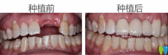 東莞固德口腔周毅門牙缺失種植牙案例圖 東莞固德口腔周毅門牙缺失種植牙案例圖