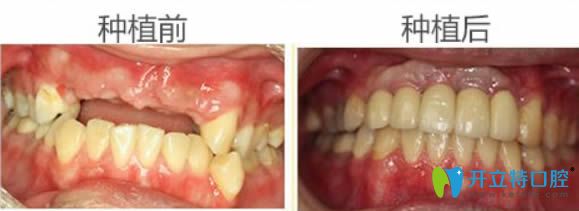 東莞固德周毅院長全口牙缺失種植前后對比效果 東莞固德周毅院長全口牙缺失種植前后對比效果