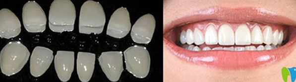 黃牙怎么形成 ?深圳嵐世紀口腔介紹瓷貼面美白牙齒優(yōu)缺點