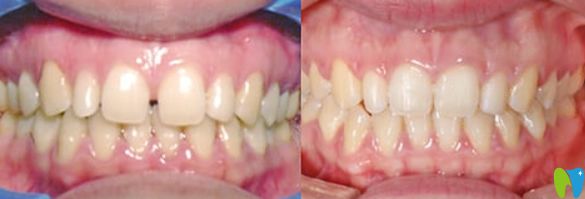 佛山粵冠牙科牙齒正畸前后對(duì)比圖