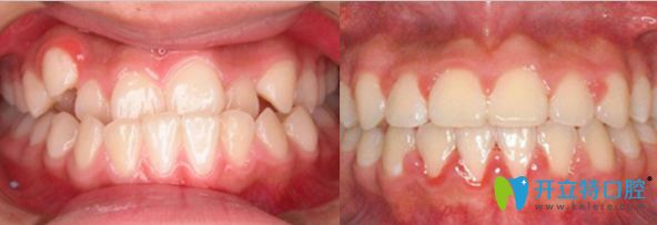 佛山粵冠口腔看牙怎么樣?顧客的牙齒矯正案例效果反饋