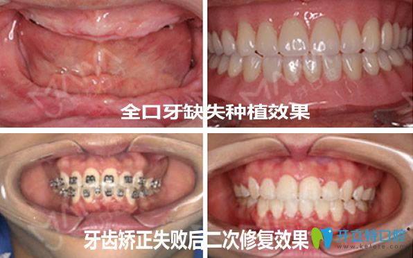 麥芽口腔種植牙及牙齒矯正效果案例