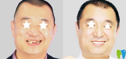 惠州麥芽口腔多顆牙缺失種植效果案例 惠州麥芽口腔多顆牙缺失種植效果案例