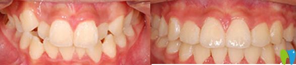 好民生口腔牙齒矯正前后效果 好民生口腔牙齒矯正前后效果
