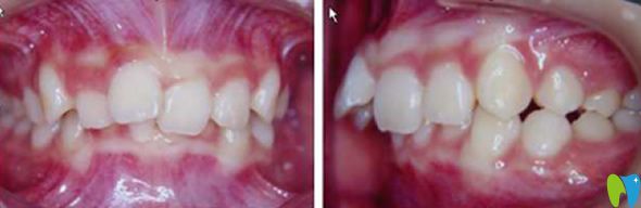 中山好民生口腔沒做牙齒矯正前的照片 中山好民生口腔沒做牙齒矯正前的照片