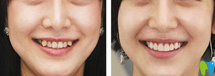 清遠(yuǎn)中大口腔牙齒矯正前后效果對比圖
