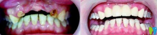 好民生口腔半口牙缺失微創(chuàng)種植效果