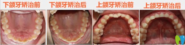 牙齒正畸后下頜牙和上頜牙的前后對比照