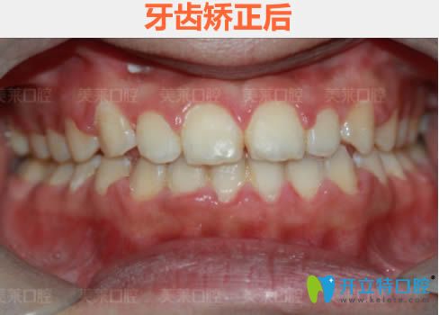 在廣州美萊口腔做完時代天使隱形矯正18個月效果