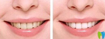 中大口腔冷光美白牙齒前后效果對比圖