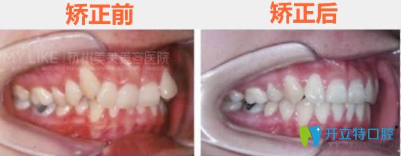 廣州美萊胡祥牙齒矯正前后對比效果