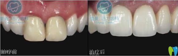 廣州美萊牙科烤瓷牙修復(fù)前后對(duì)比效果 廣州美萊牙科烤瓷牙修復(fù)前后對(duì)比效果