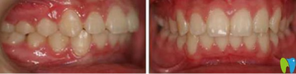 中山好民生口腔雷永正醫(yī)生做牙齒矯正好且收費(fèi)不貴