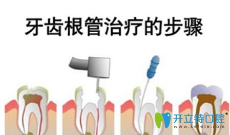 牙齒根管治療步驟和過(guò)程 牙齒根管治療步驟和過(guò)程