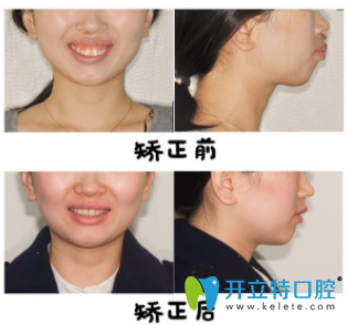 偉聯(lián)口腔黃淑微隱適美牙齒矯正前后效果對比圖 偉聯(lián)口腔黃淑微隱適美牙齒矯正前后效果對比圖