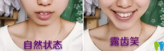 過了牙齒矯正年齡 我找中山香山口腔譚智堅(jiān)做了矯正