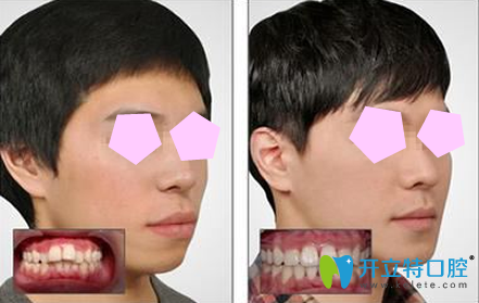 廣州偉聯(lián)口腔牙齒矯正效果對比圖 廣州偉聯(lián)口腔牙齒矯正效果對比圖