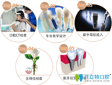廣州偉聯(lián)口腔種植牙過程圖 廣州偉聯(lián)口腔種植牙過程圖