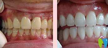 清遠中大口腔洗牙前后效果對比圖