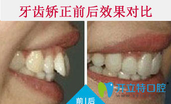 清遠中大口腔牙齒矯正前后效果對比圖