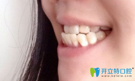 沒(méi)有去蘇州美奧口腔做牙齒矯正前側(cè)面照