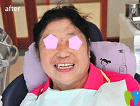 暨博口腔即可種植牙術(shù)后效果圖