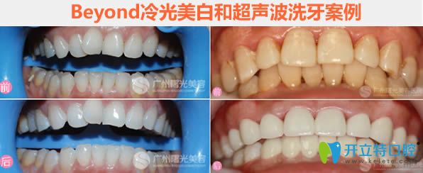 Beyond冷光美白和超聲波洗牙前后對(duì)比圖 Beyond冷光美白和超聲波洗牙前后對(duì)比圖