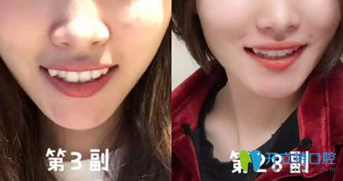 我在廣州德倫口腔做隱適美牙齒矯正過程中 我在廣州德倫口腔做隱適美牙齒矯正過程中