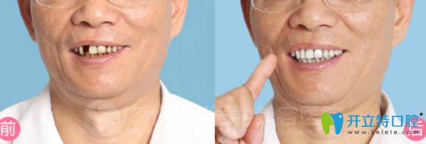 廣州曙光即刻種植牙前后對比效果 廣州曙光即刻種植牙前后對比效果