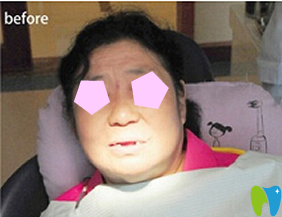 老年人可以種植牙嗎 65歲老人在廣州暨博口腔做即刻種植牙