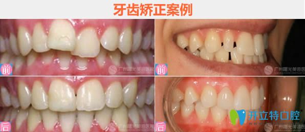 廣州曙光王浩主任隱形牙齒矯正前后對(duì)比效果 廣州曙光王浩主任隱形牙齒矯正前后對(duì)比效果