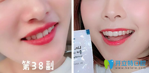 本人在德倫口腔做隱適美牙齒矯正一年的效果 本人在德倫口腔做隱適美牙齒矯正一年的效果