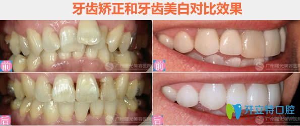 廣州曙光口腔李錦鴻牙齒擁擠及牙齒美白前后對(duì)比效果 廣州曙光口腔李錦鴻牙齒擁擠及牙齒美白前后對(duì)比效果