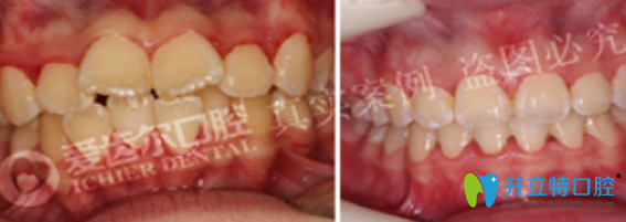武漢愛齒爾口腔好不好？來看牙齒矯正案例