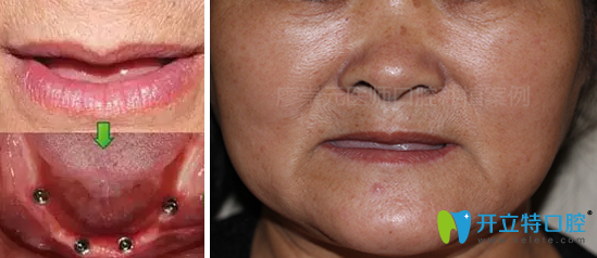 來看廣州好大夫口腔廖崇元為六旬老人種植全口牙效果如何