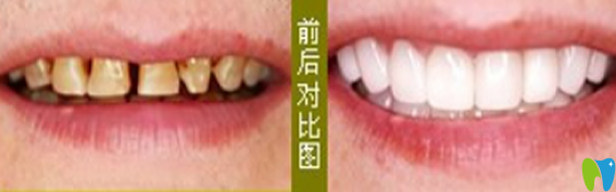 在武漢愛齒爾口腔做牙齒修復(fù)治療前后對比圖