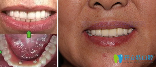 廣州好大夫口腔廖崇元即刻種植牙案例術(shù)后效果 廣州好大夫口腔廖崇元即刻種植牙案例術(shù)后效果