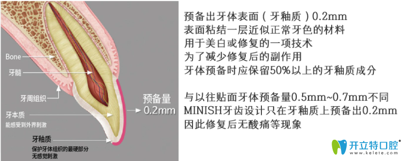 較少磨牙的minish牙齒貼面技術實現(xiàn)牙齒美白