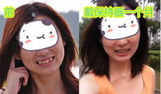 虎牙矯正案例:武漢愛(ài)齒爾口腔牙齒正畸15月終于摘掉牙套嘍