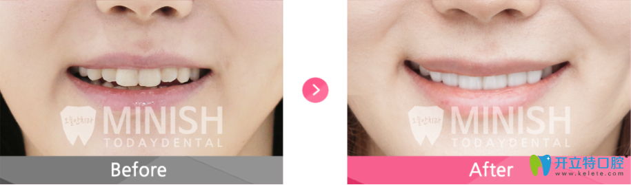 難看牙齒通過minish牙齒設計的案例對比