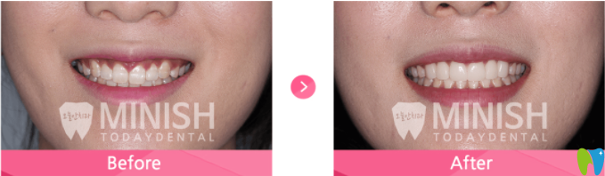 牙齦露出過多難看的minish設計前后對比案例圖