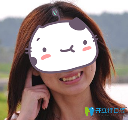 沒(méi)有武漢愛(ài)齒爾口腔正畸前樣子 沒(méi)有武漢愛(ài)齒爾口腔正畸前樣子