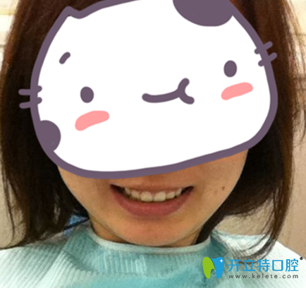 武漢愛(ài)齒爾口腔牙齒正畸15個(gè)月剛摘掉牙套照 武漢愛(ài)齒爾口腔牙齒正畸15個(gè)月剛摘掉牙套照